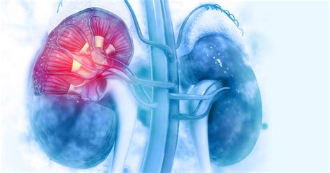 Ndi can also occur as a secondary complication, most commonly from obstructive uropathy or chronic lithium therapy. Diabetic Kidney Disease - The Arab Hospital Magazine