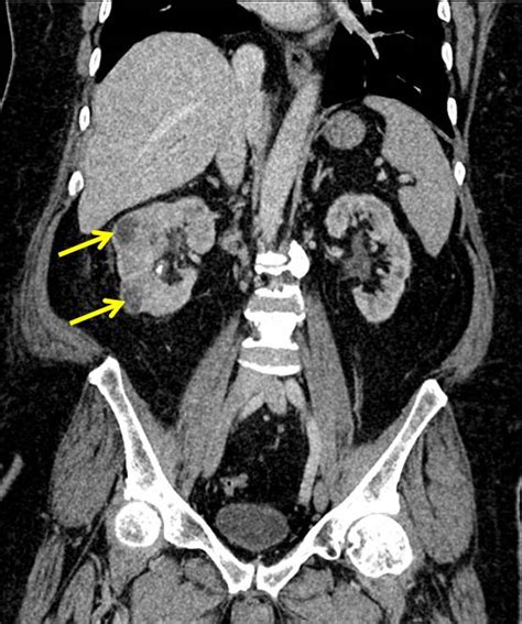 Renal Abscesses Radiology Cases