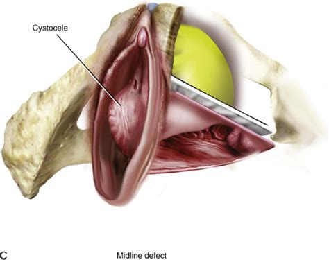 Vaginal Repair Of Cystocele Rectocele And Enterocele Obgyn Key