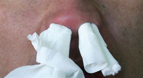 Man S Runny Nose Turns Out To Be Leaking Brain Fluid