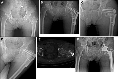 High Failure Rate Of Proximal Femoral Locking Plates In Fixation Of
