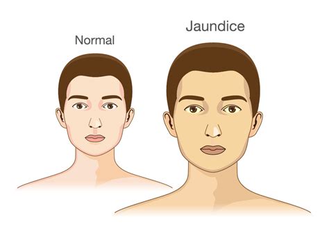 Jaundice Symptoms Causes And Treatment Apollo Hospital Blog