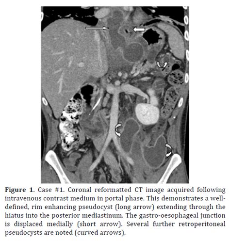 Surgical Intervention For Mediastinal Pancreatic Pseudocysts A C