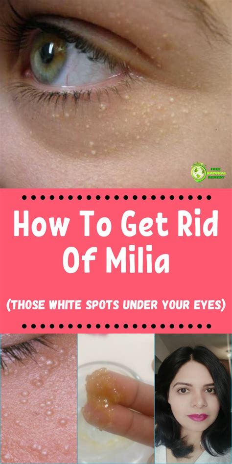 Milia Under Eye Treatment Wedding Ideas You Have Never Seen Before