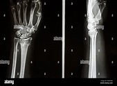 Film X Ray Show Fracture Distal Radius Colles Fracture Wrist Stock ...