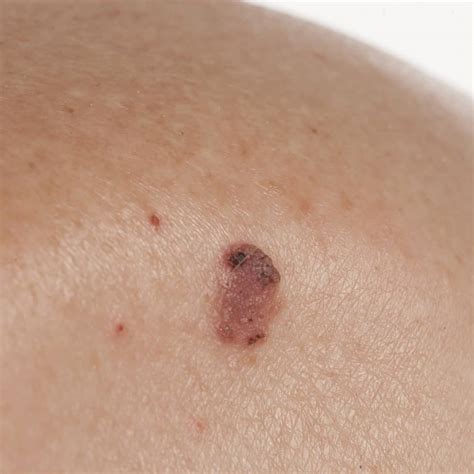 Is Basal Skin Cancer Deadly