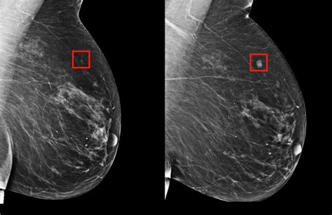 New Research Highlights How Ai Can Accurately Detect Breast Cancer