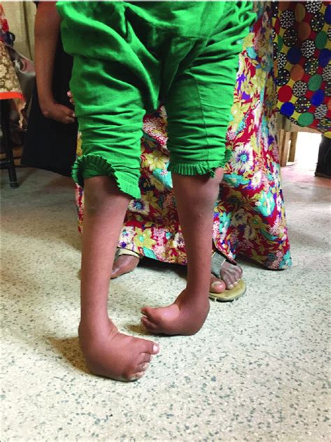 A Fully Relapsed Of Clubfoot Deformity Following Incomplete Treatment