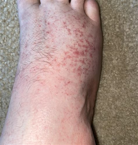 Rashhives What Is On My Foot Rdiagnoseme