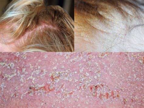Discover More Than 124 Seborrheic Dermatitis Cause Hair Loss Vn