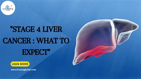 Stage 4 Liver Cancer What To Expect Livonta Global Pvt Ltd