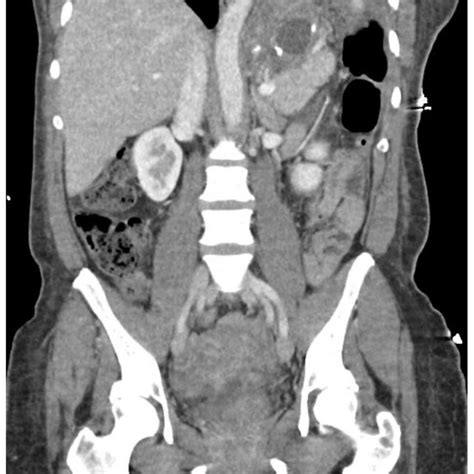 Initial Ct Showing Luq Abscess Download Scientific Diagram