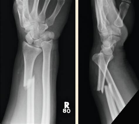 Galeazzi Fracture Dislocations Musculoskeletal Key