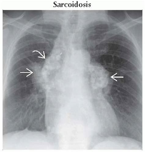 Bilateral Hilar Mass Thoracic Key