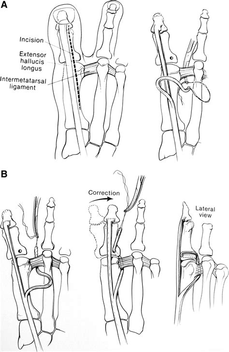 Tendon Transfers About The Hallux Foot And Ankle Clinics