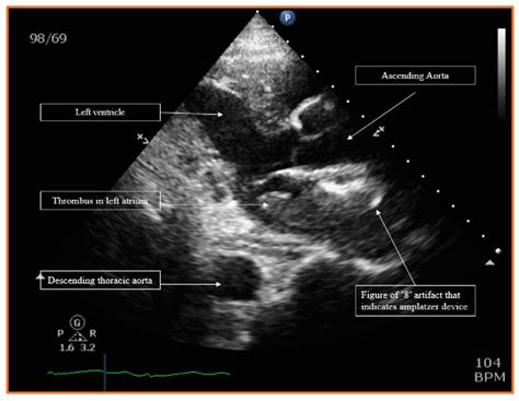 Parasternal Long Axis View Of The Transthoracic Echocardiography Which
