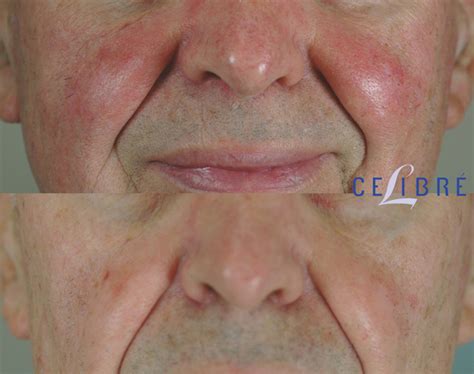 Sinewi Weide Gereiztheit Rosacea Laser Treatment Before And After