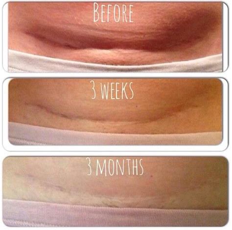 Defining Gel Not Only Lightened Her C Section Scar But It Tightened And Firmed Her Belly Pouch