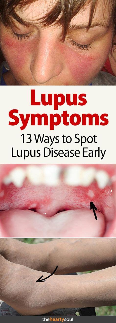 13 Warning Signs Of Lupus That May Put You In The Hospital Treat It