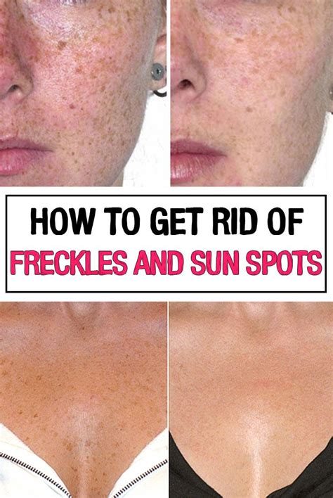 How To Get Rid Of Freckles And Sun Spots Getting Rid Of Freckles Freckles Sunspots