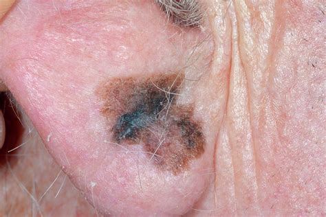 Skin Cancer Photograph By Dr P Marazzi Science Photo Library
