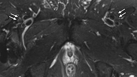 High Resolution 3 T Mr Neurography Of Femoral Neuropathy Ajr