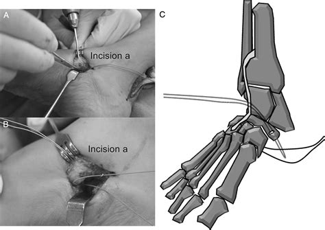 An Innovative Anchoring Technique For Anterior Transfer Of The Tibialis Posterior Tendon The