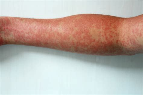 8 Symptoms Of Measles Facty Health