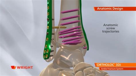 Ortholoc™ 3di Ankle Fracture System Animation 009271 Broadcastmed