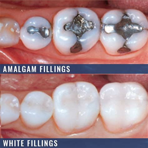 White Fillings Amalgam Fillings Benson Dental Practice