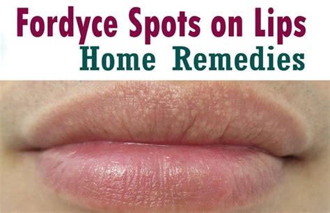 Fordyce Spots On Lips Removal