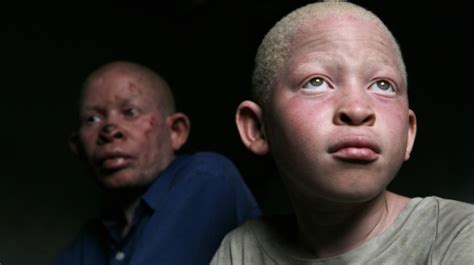 Scary😟 In Tanzania Albinos Are Hunted Down And Their Bodies Are