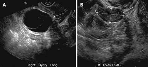 Multimodality Imaging Of Ovarian Cystic Lesions Review With An Imaging
