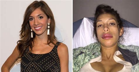 Big Gob Farrah Abraham Left Disfigured With Giant Lips After Botched Implants Daily Star