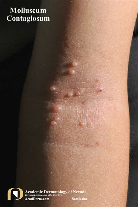 Molluscum Contagiosum Skin Lesions Also Called Water Warts Royalty Free
