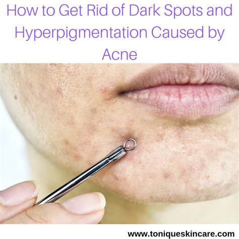 How To Get Rid Of Dark Spots And Hyperpigmentation Caused By Acne