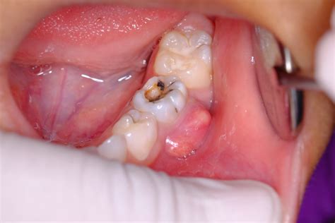 Baby Tooth With Abscess Drimneet