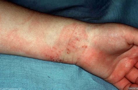 Rashes In Adults Pictures Photos