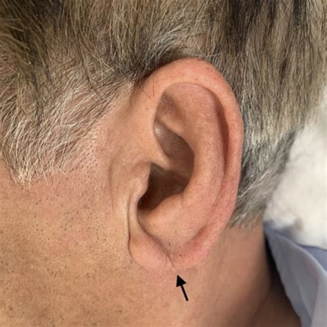 Franks Sign A Diagonal Crease Running Across The Earlobes At A 45