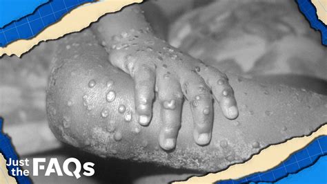 What is monkeypox and how do you get it?