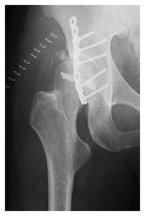 Case 1 A Anteroposterior X Ray Image Of The Right Hip After Open
