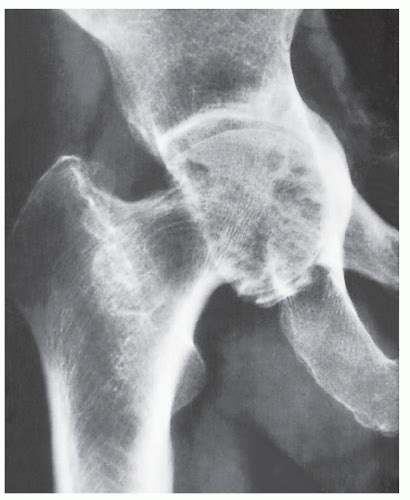 Degenerative Joint Disease Radiology Key