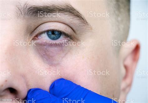 Bags Under The Eyes Hernias On The Face Of A Man Plastic Surgeon