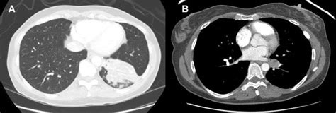 Ct Scan Of The Chest Lung Windows A And Mediastinal Windows B