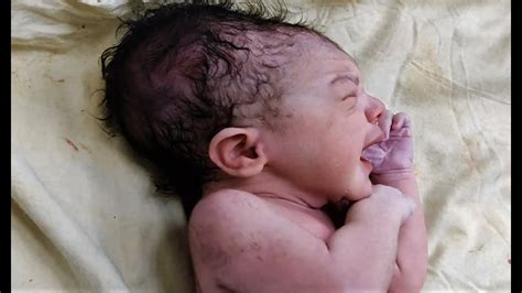 Cute Newborn Baby With Cone Shaped Head Caput Succedaneum Newborn