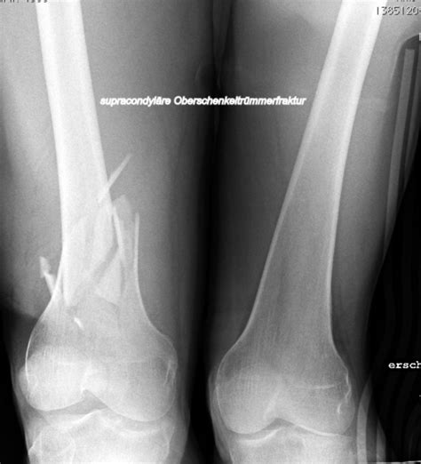 Comminuted Fracture Of Femur In Polytrauma Patient Doccheck