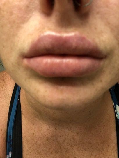 Little White Lumps After Lip Fillers