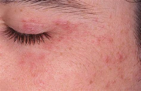 Periocular Dermatitis Pictures Symptoms And Pictures