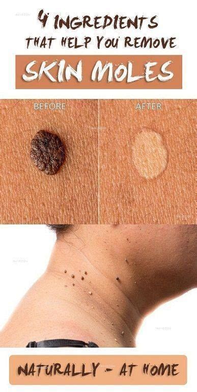 How To Remove Moles Warts Blackheads Skin Tags In 2020 Skin Moles