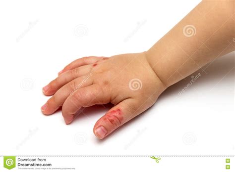 Hand Of A Child With Atopic Eczema Stock Image Image Of Disease